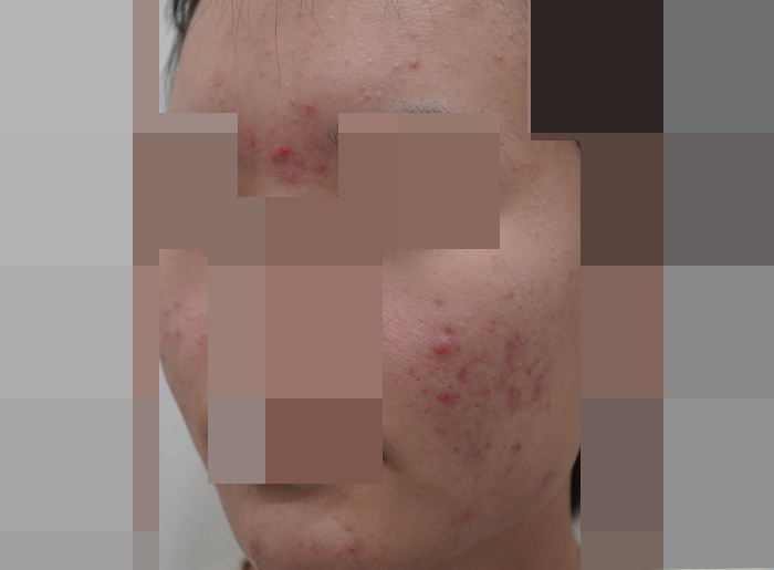 모낭염 치료 전 사진