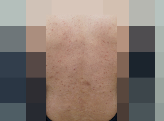 등여드름 치료 전 사진