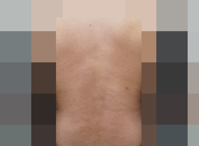 등여드름 치료 후 사진