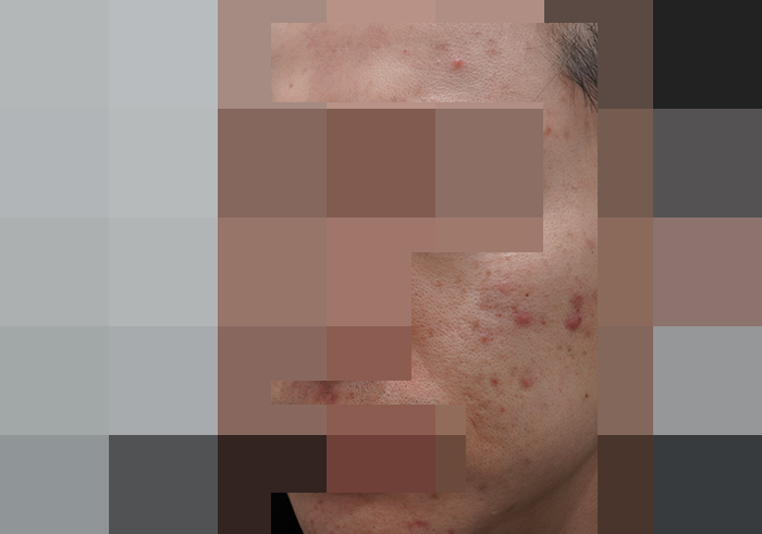 모낭염 치료 전 사진