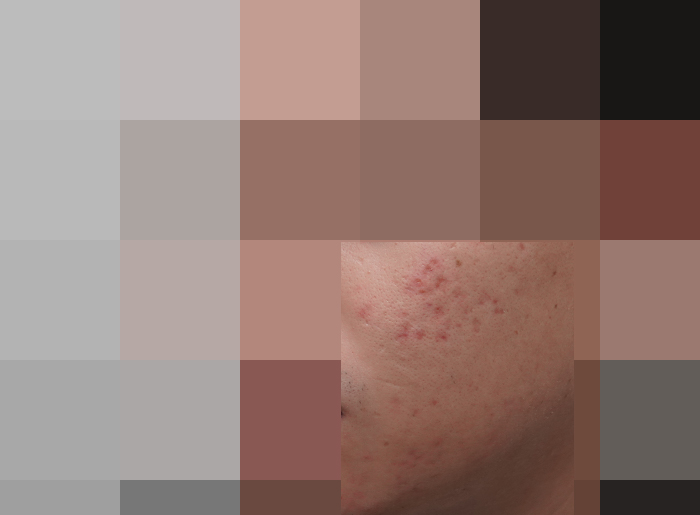 모낭염 치료 후 사진