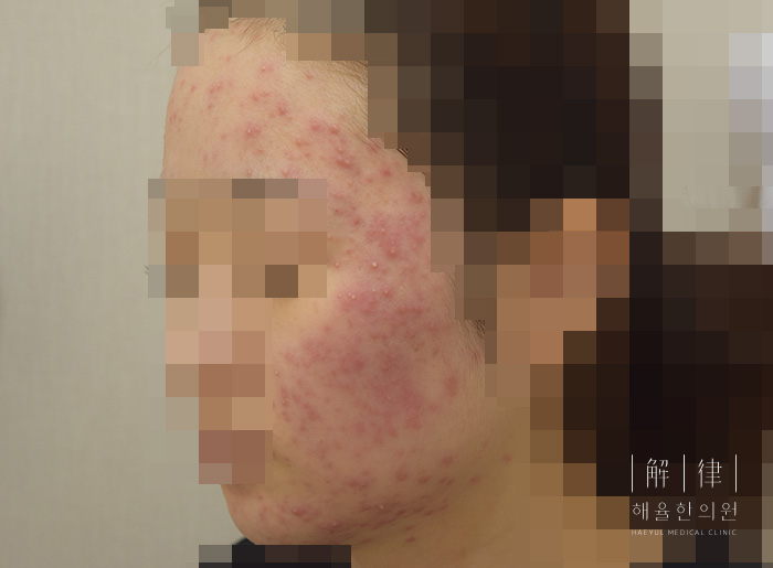 안산점 공개 여드름 사례 치료 전 사진
