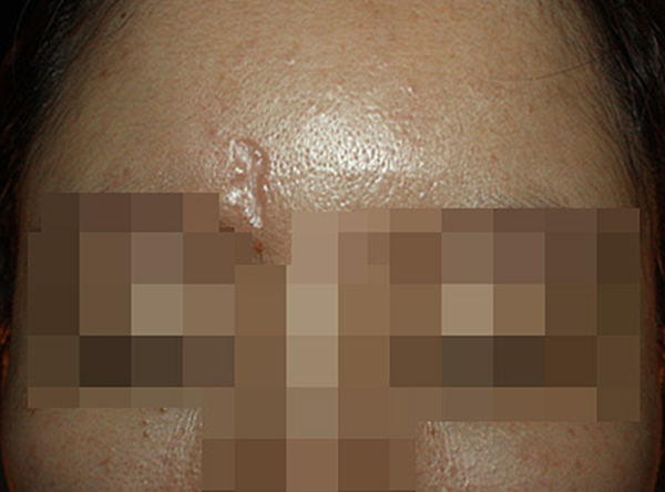 [안산점] 손톱/수두흉터/점뺀흉터 치료 전 사진 - 해율한의원