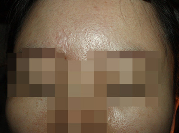 [안산점] 손톱/수두흉터/점뺀흉터 치료 후 사진 - 해율한의원