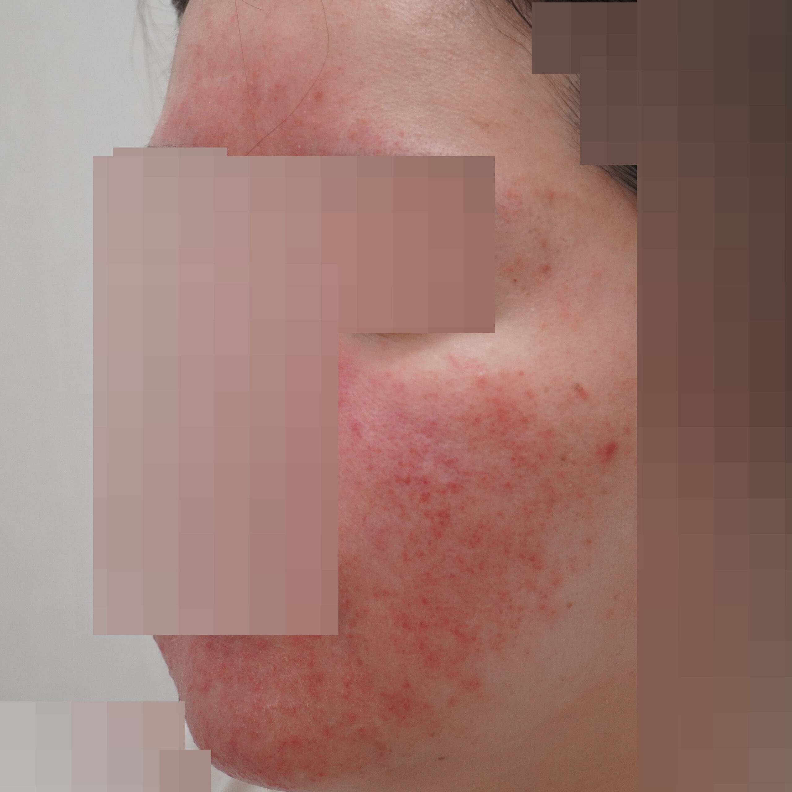 주사피부염 안내를 위해 제공된 볼 사진