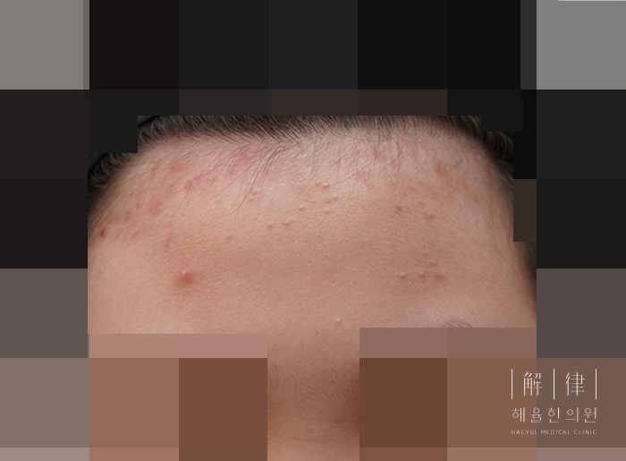 지루피부염 안내를 위해 제공된 이마 사진