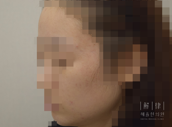 여드름 치료 후 사례 사진