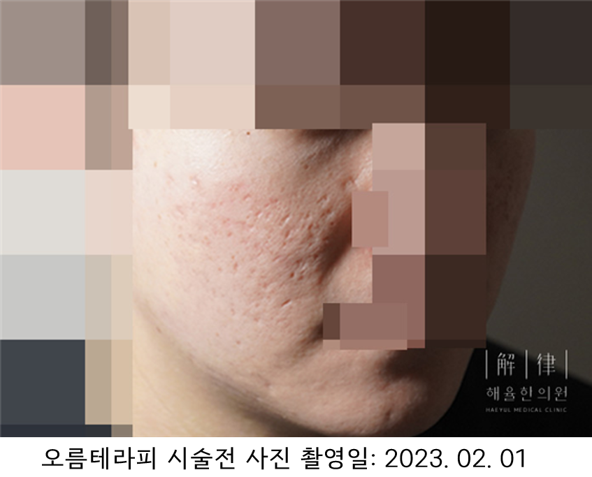 시술 전 사례 사진, 2023년 2월 1일 촬영