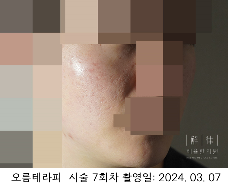 시술 7회차 사례 사진, 2024년 3월 7일 촬영