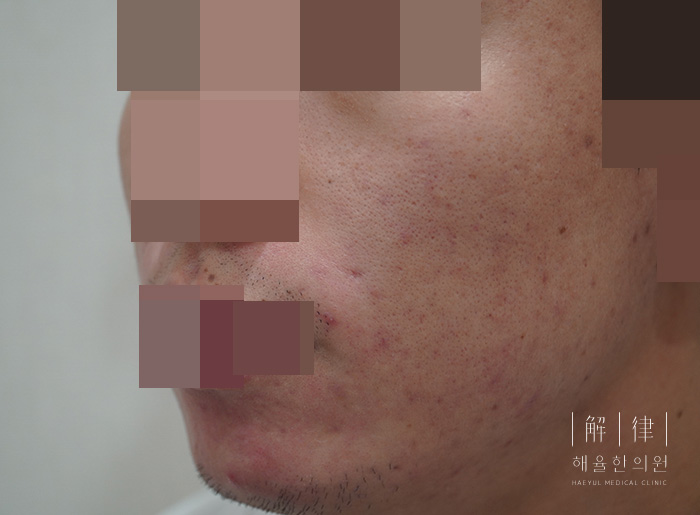 모낭염 치료 후 사례 사진