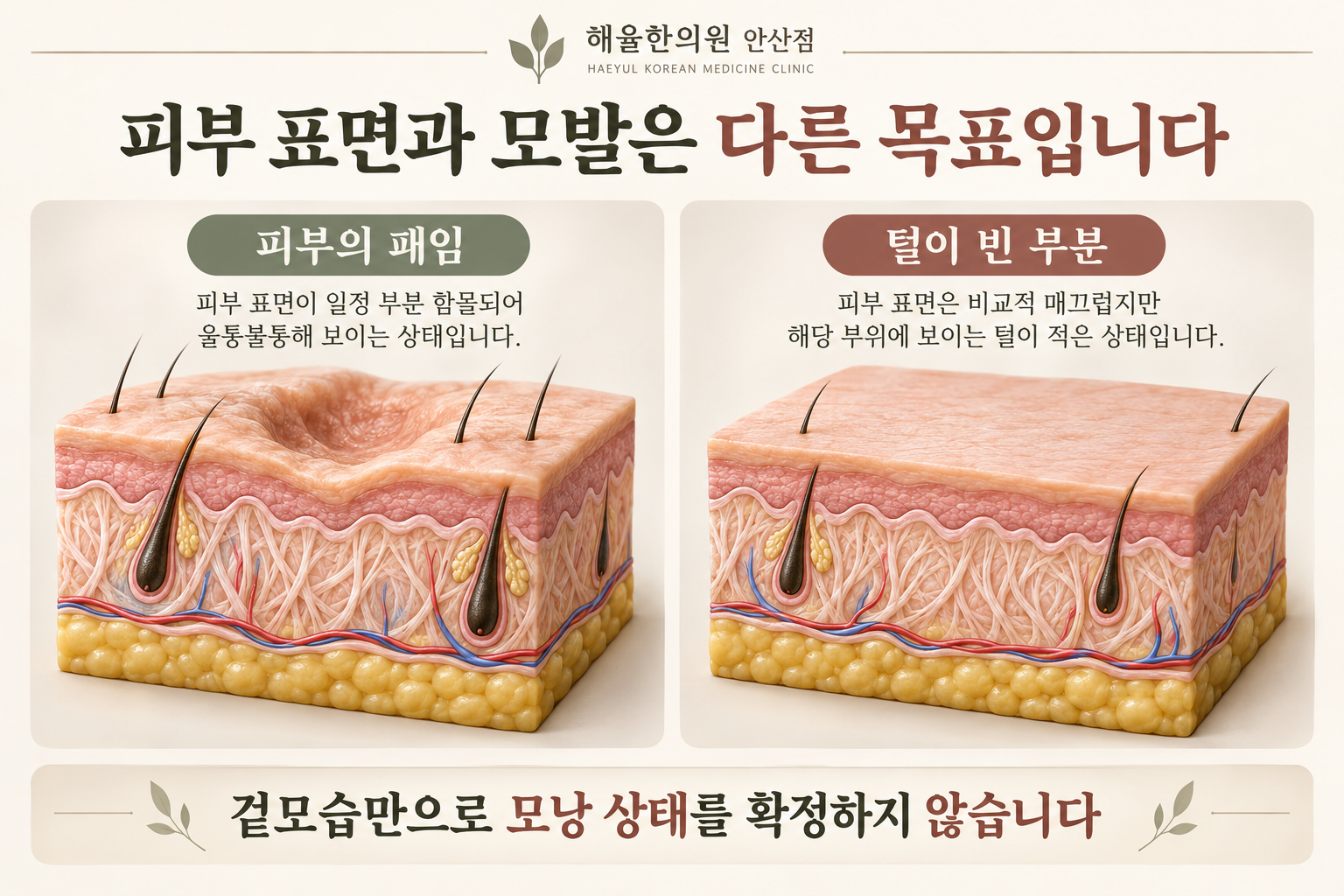 피부의 패임과 털이 빈 부분을 나누어 비교한 개념도