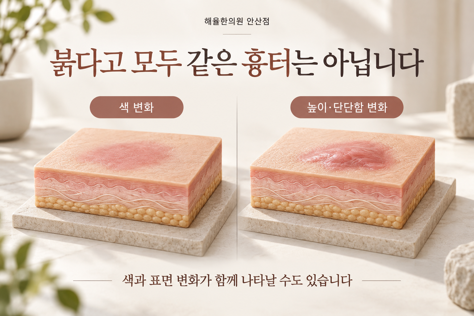 평평한 색 변화와 높이 및 단단함이 달라진 피부 표면을 비교한 모형