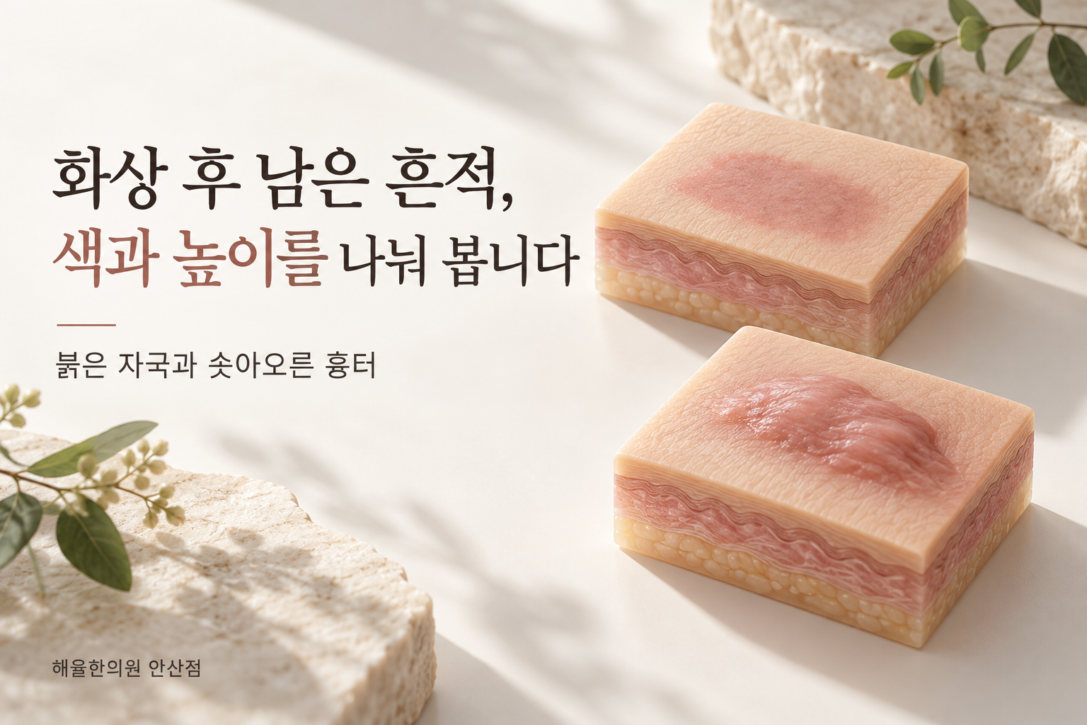 화상이 아문 뒤 평평한 색 변화와 솟아오른 흉터를 나란히 표현한 피부 모형