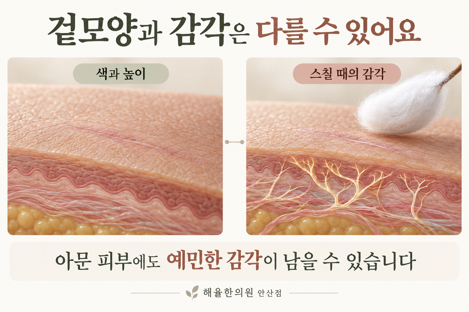 아문 피부의 색과 높이 및 피부 아래 감각 신경을 나누어 표현한 그림