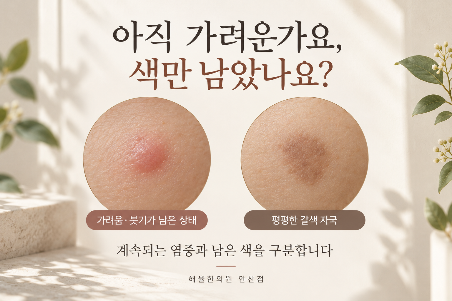 가려움과 붓기가 남은 피부와 평평한 갈색 자국을 나누어 보여주는 그림