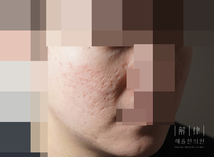 모자이크 처리된 비포 사례 사진