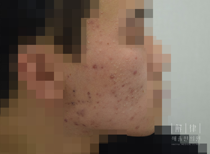모자이크 처리된 비포 사례 사진