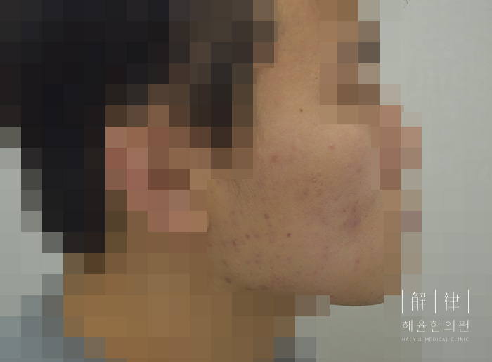 모자이크 처리된 애프터 사례 사진