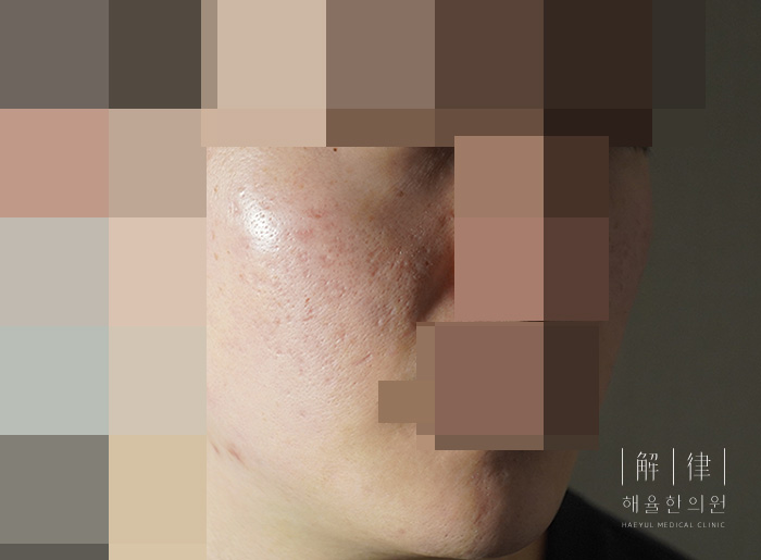 모자이크 처리된 애프터 사례 사진