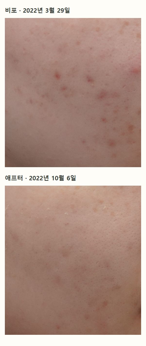 비포·애프터 사례 사진