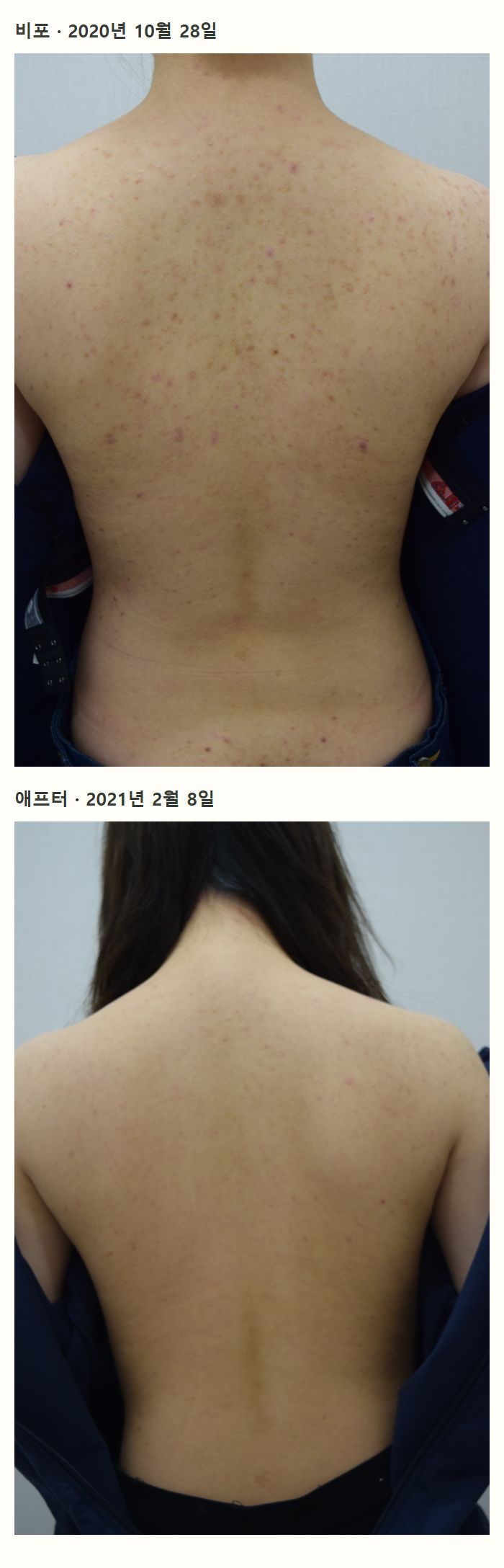 비포·애프터 사례 사진