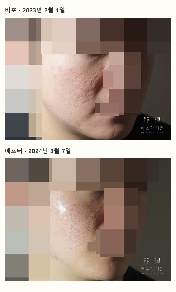 비포·애프터 사례 사진