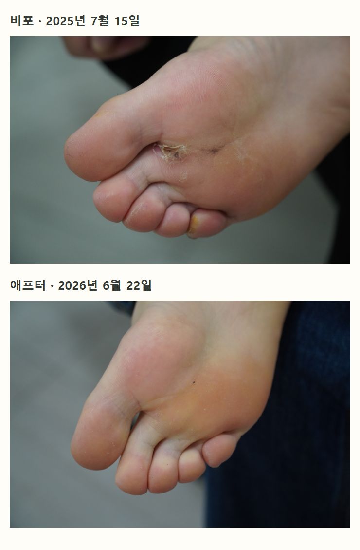 비포·애프터 사례 사진