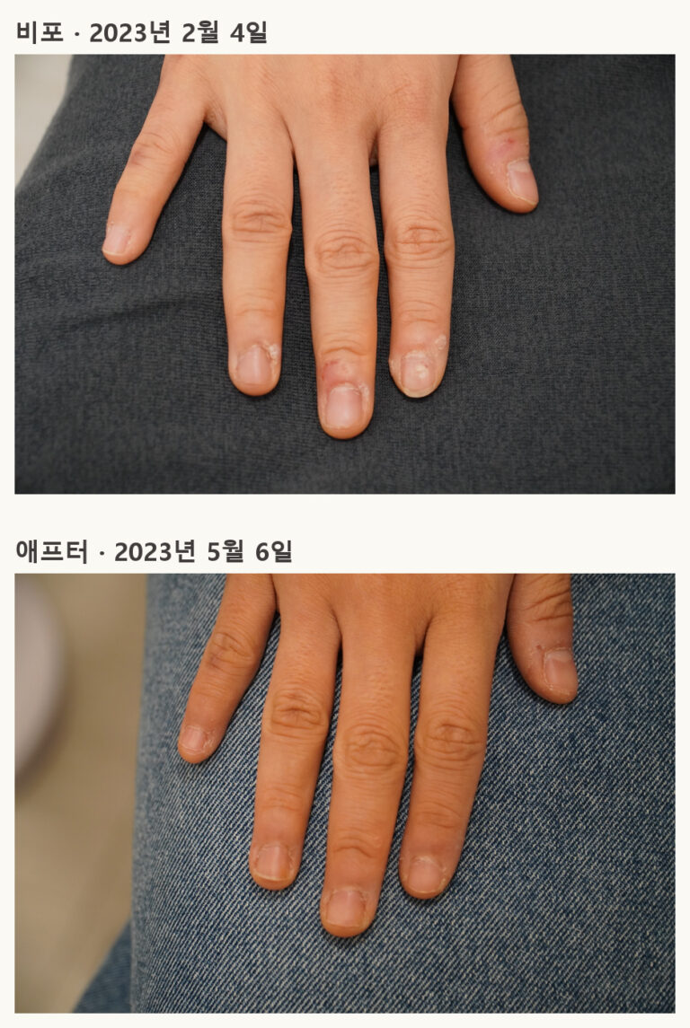 비포·애프터 사례 사진