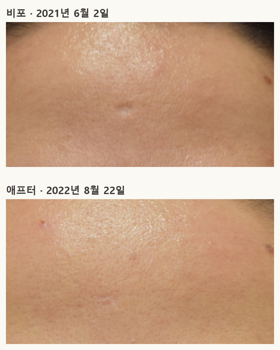 같은 이마 부위의 비포·애프터 사례 사진, 2021년 6월 2일과 2022년 8월 22일 촬영