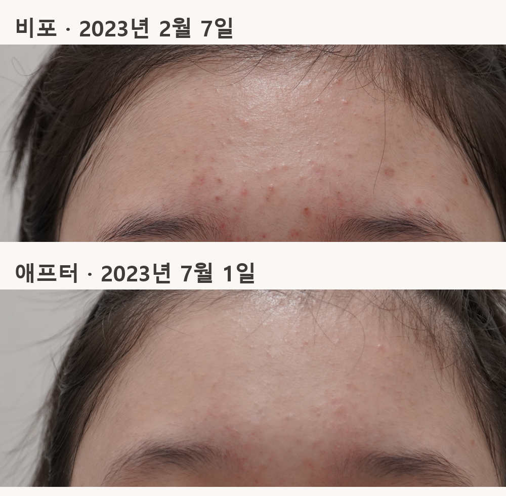 같은 이마 부위의 비포·애프터 사례 사진, 2023년 2월 7일과 7월 1일 촬영
