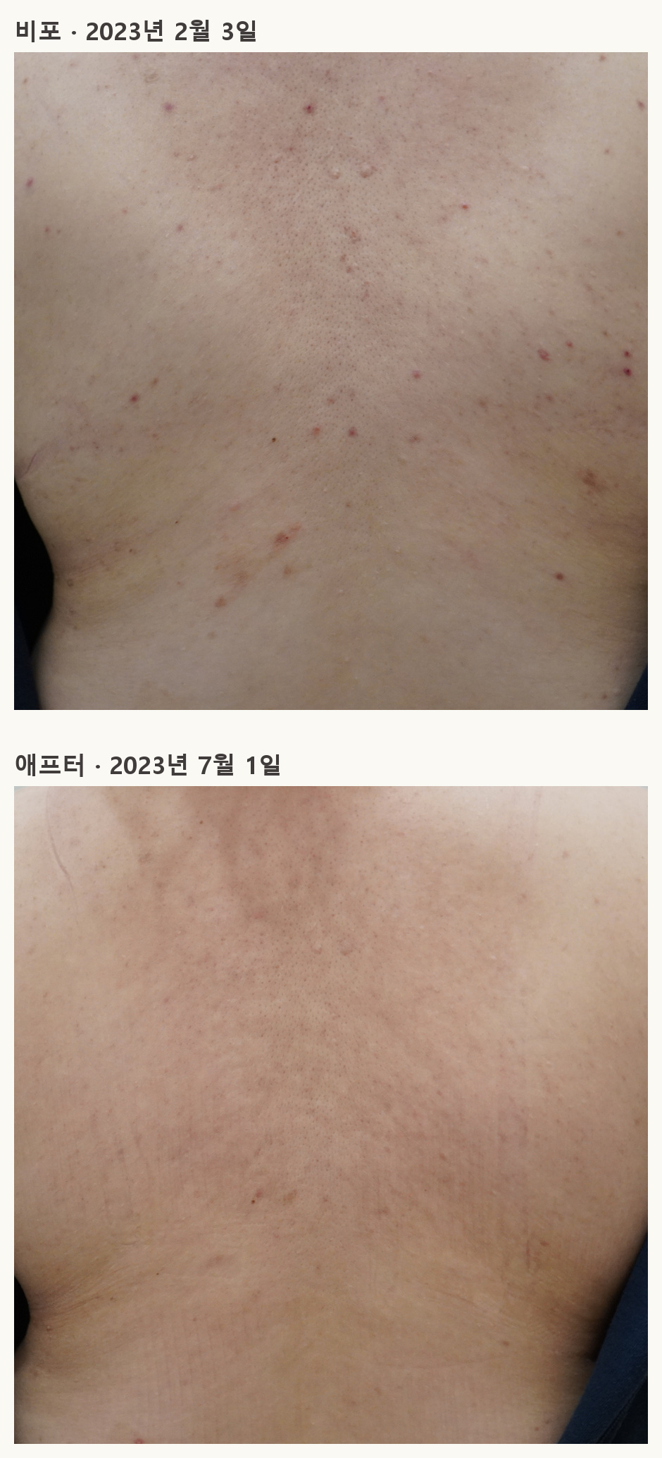같은 등 부위의 비포·애프터 사례 사진, 2023년 2월 3일과 7월 1일 촬영