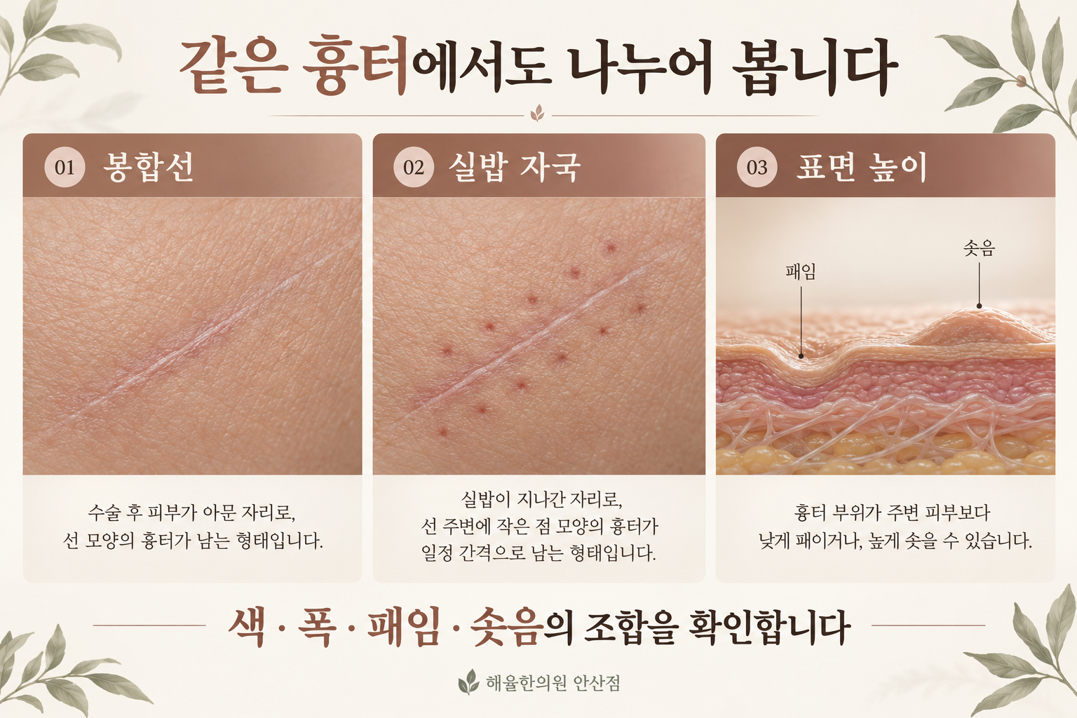 봉합선, 실밥 자국, 피부 표면의 높이를 나누어 보여주는 비교 그림