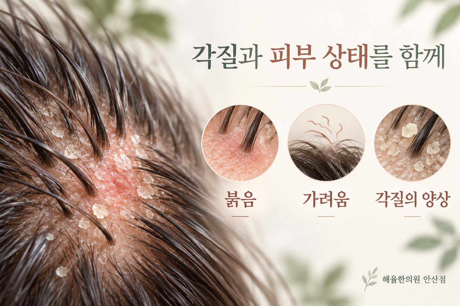 붉음과 가려움, 각질 양상을 함께 살펴보는 두피 확대 모형