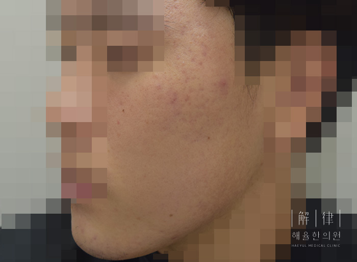 모자이크 처리된 애프터 사례 사진