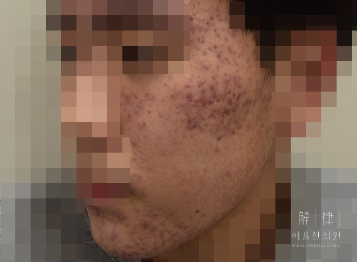 모자이크 처리된 비포 사례 사진
