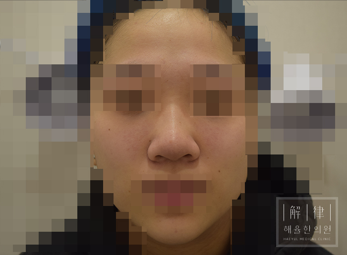 모자이크 처리된 애프터 사례 사진