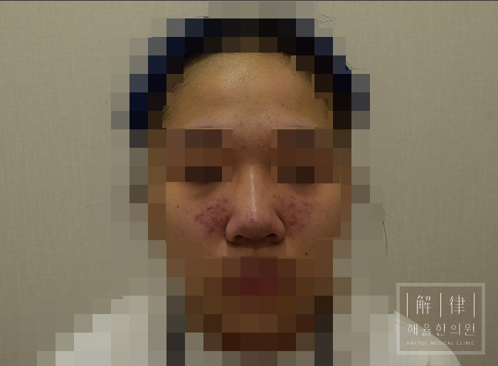 모자이크 처리된 비포 사례 사진