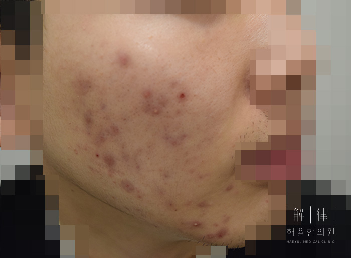 모자이크 처리된 비포 사례 사진