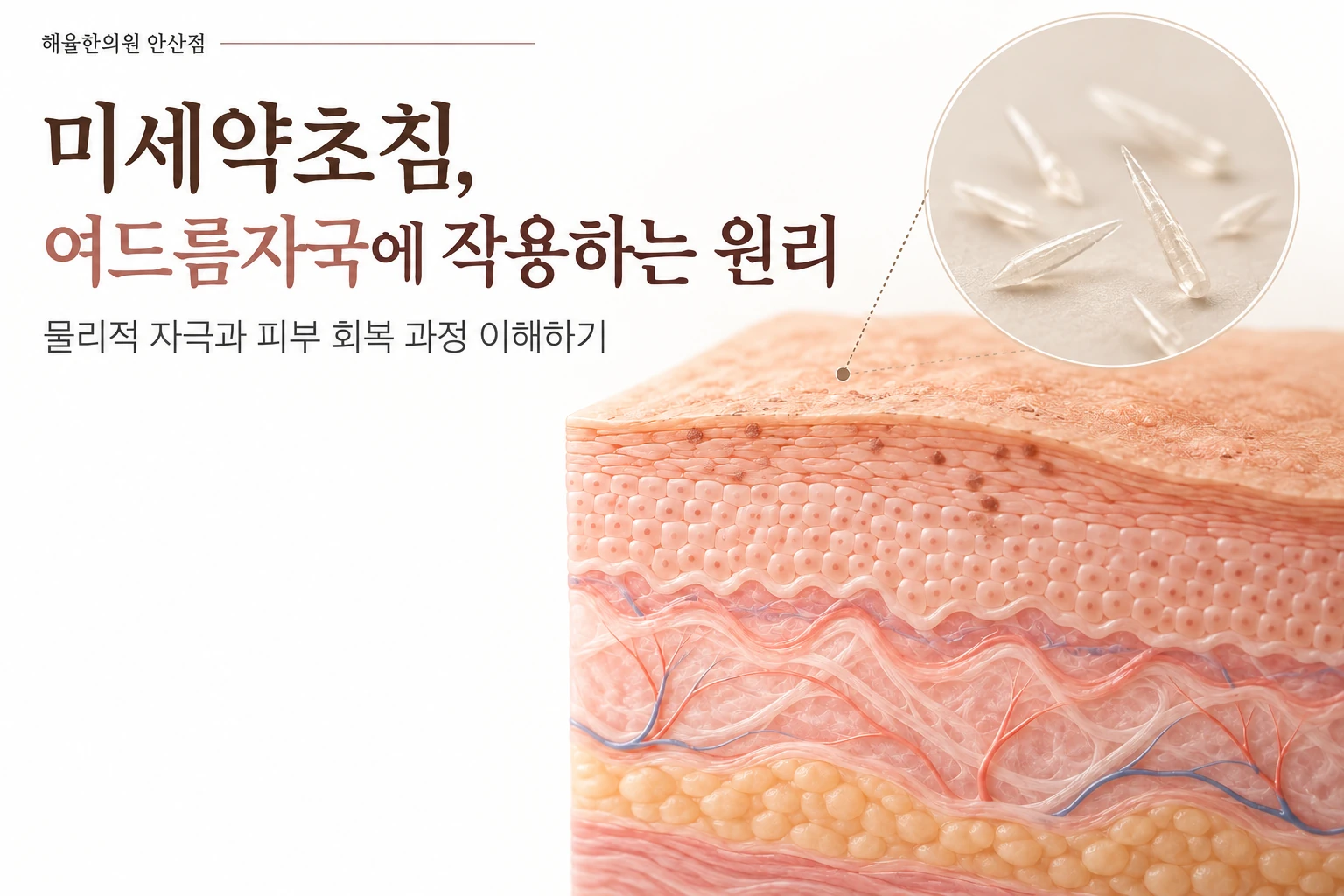 미세약초침 작용 원리 칼럼 썸네일