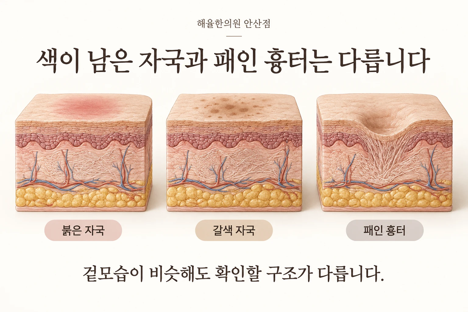 갈색 자국과 붉은 자국, 패인 흉터의 차이