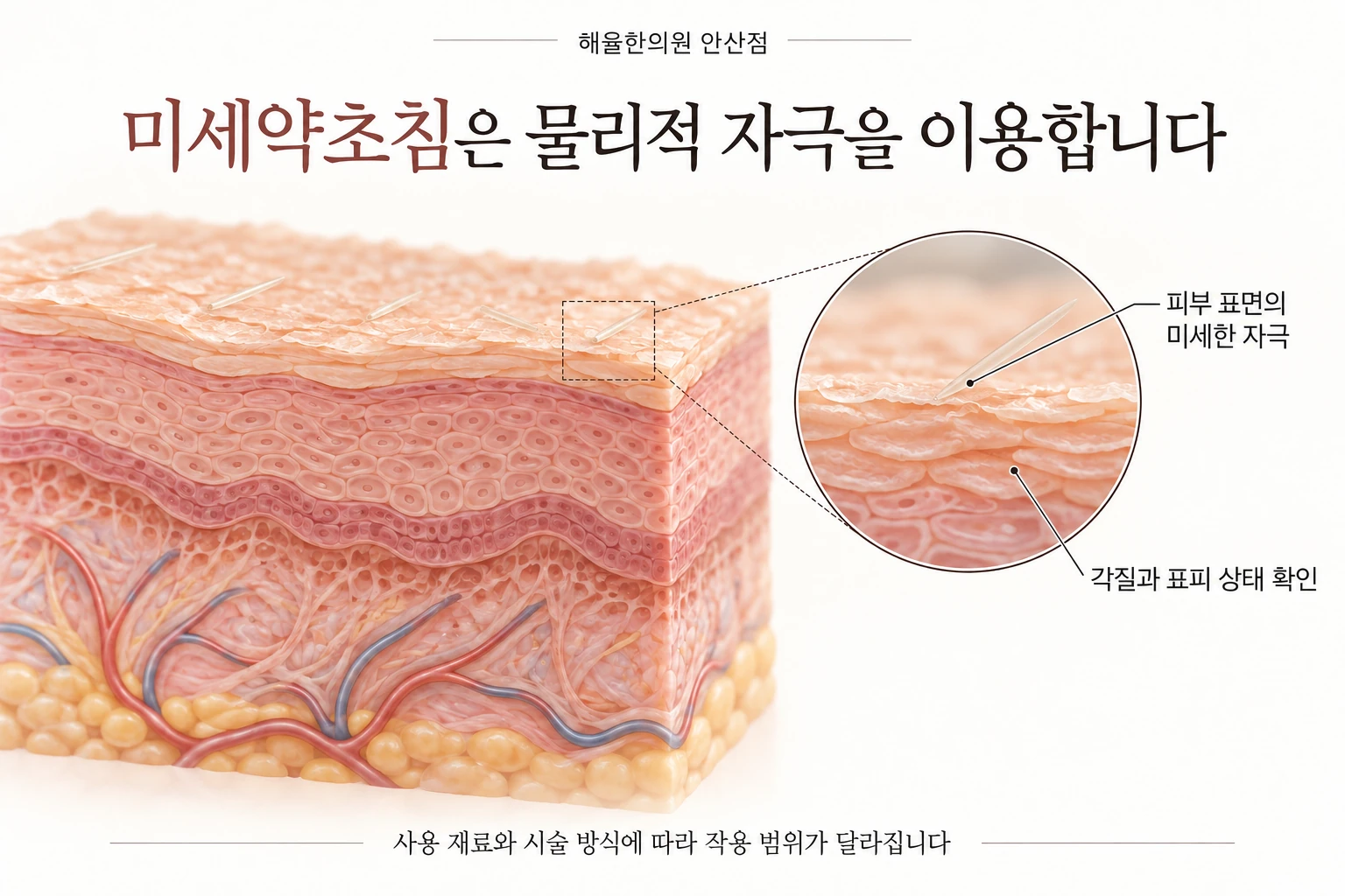 미세한 침 모양 입자가 피부 표면에 주는 물리적 자극