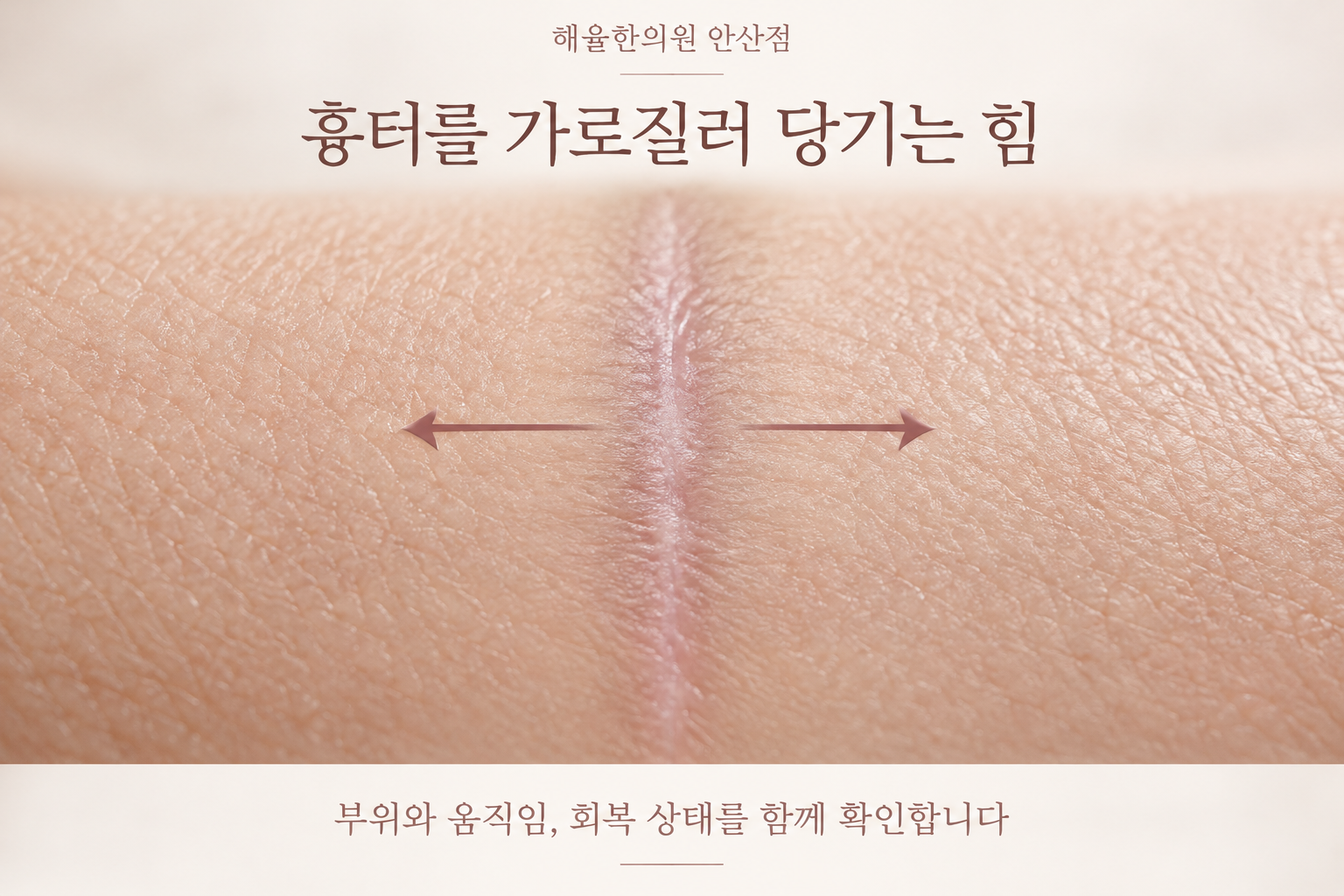 닫힌 흉터를 가로질러 작용하는 장력