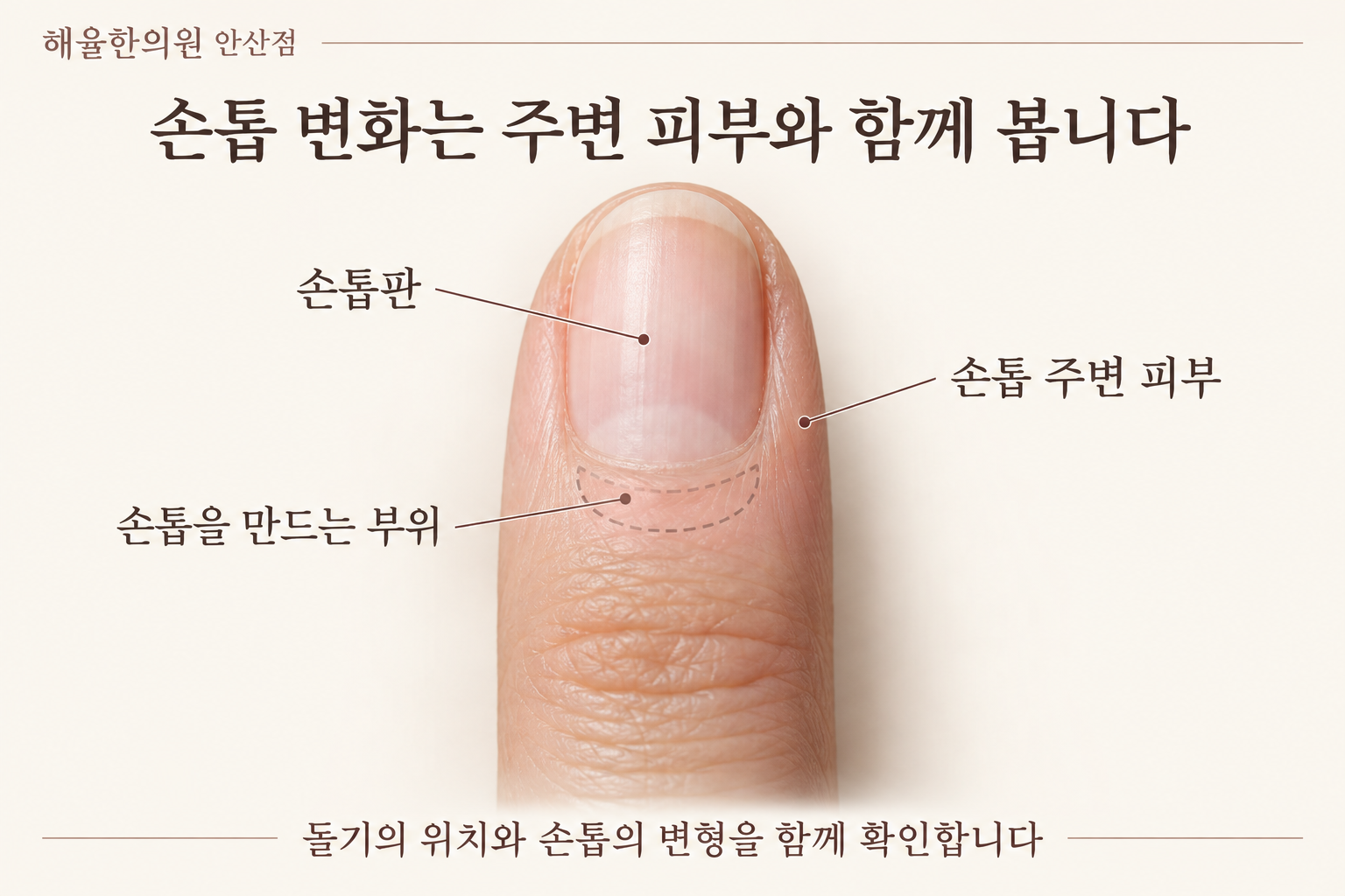 손톱판과 손톱 뿌리의 형성 부위 및 주변 피부