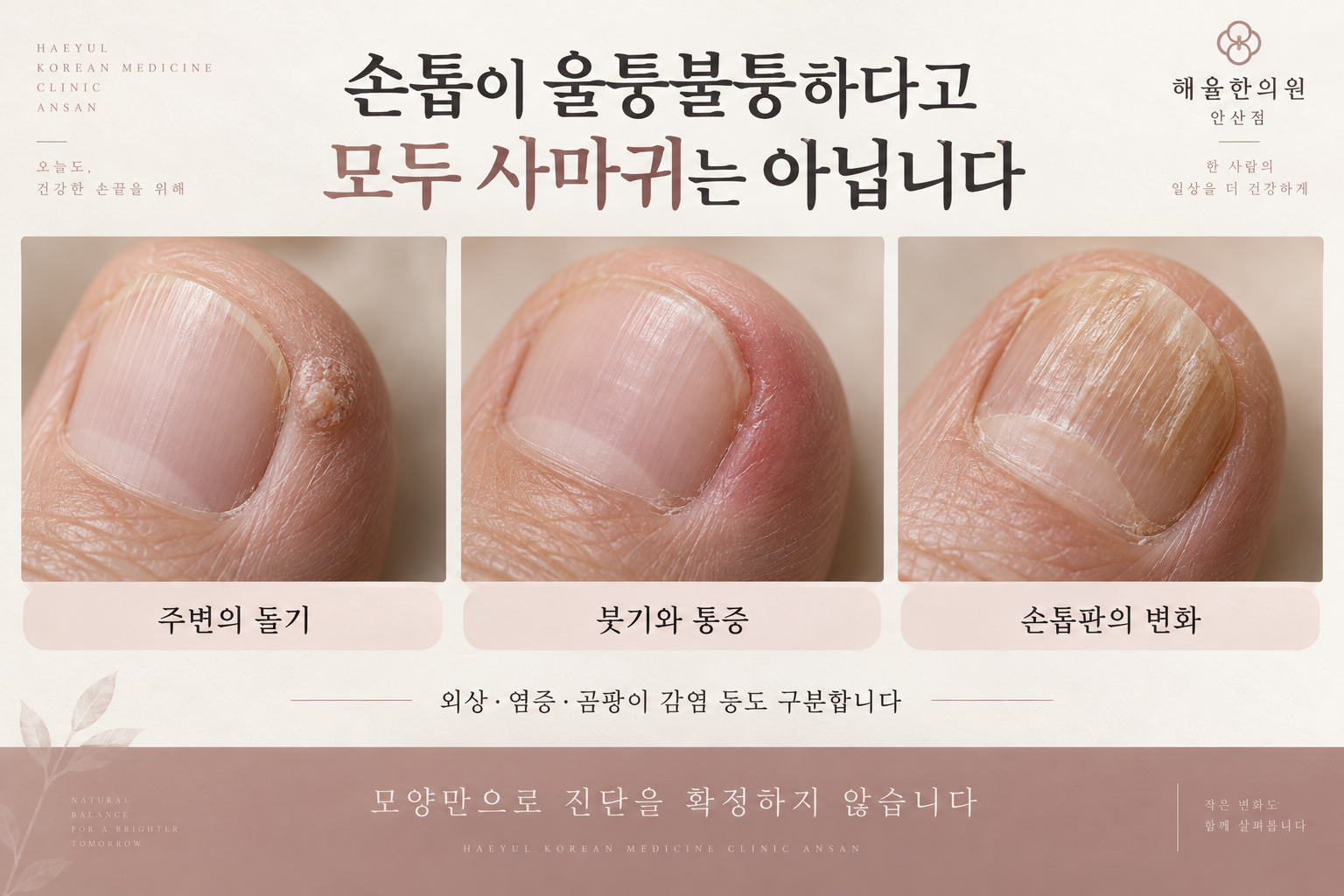 주변 돌기와 염증 및 손톱판 변화의 구분