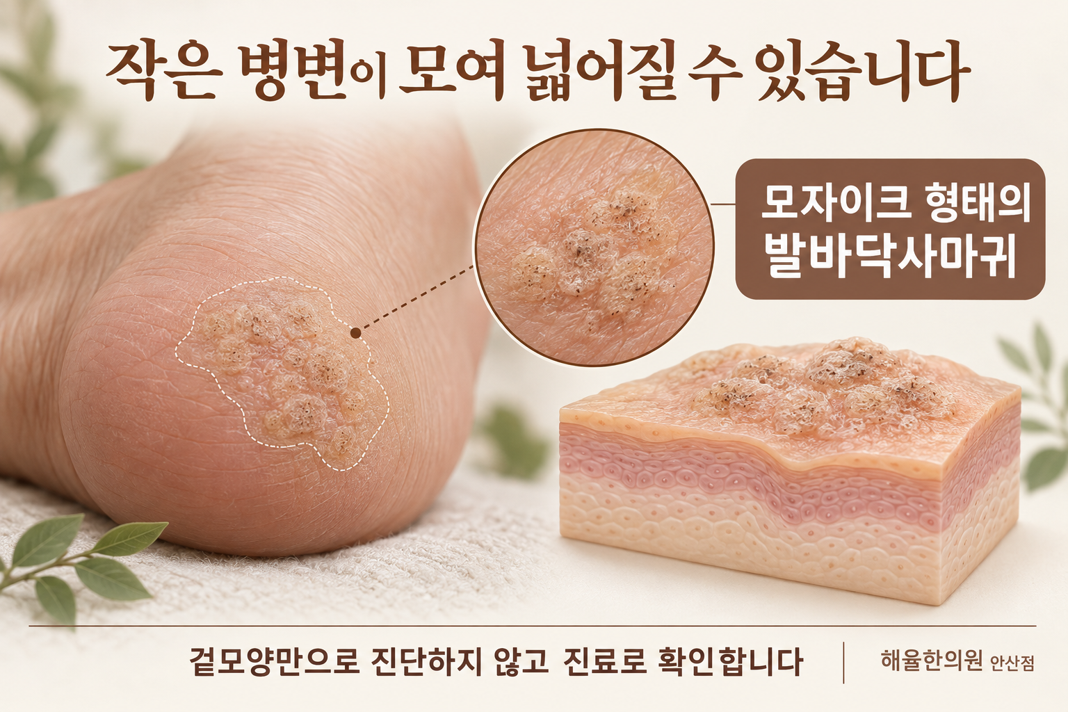 작은 병변이 모여 넓어지는 모자이크 형태의 발바닥사마귀