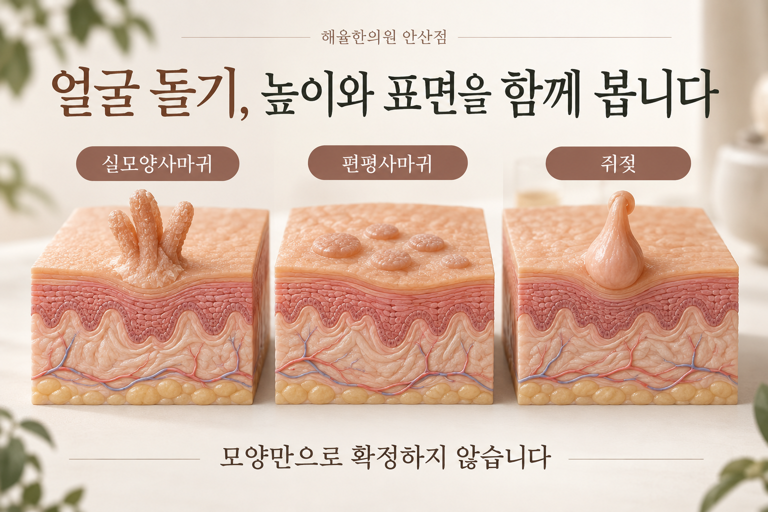 실모양사마귀·편평사마귀·쥐젖의 표면 형태 개념 비교