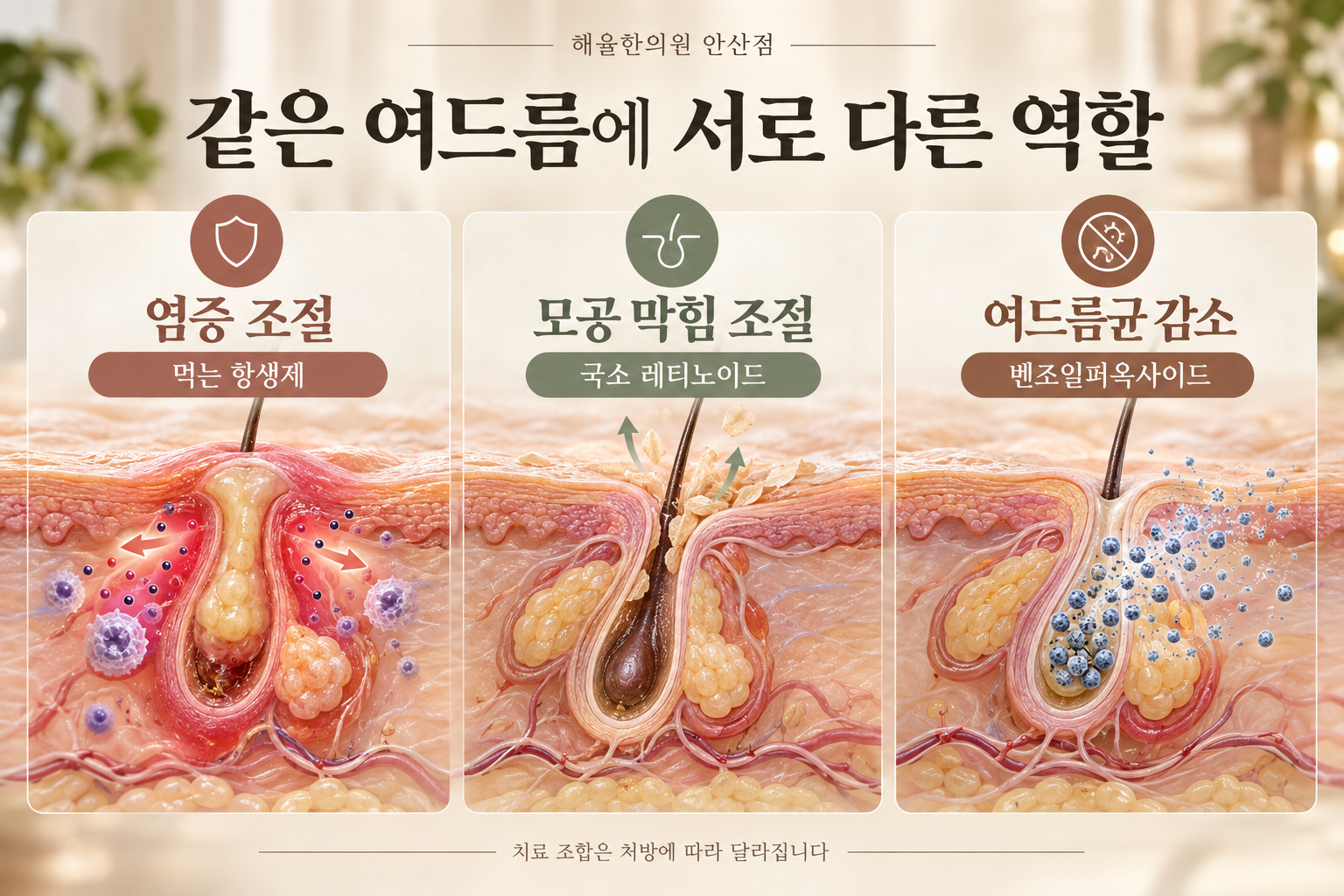 항생제·국소 레티노이드·벤조일퍼옥사이드의 서로 다른 역할